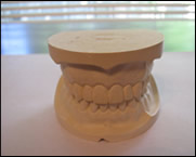 A sample dental cast