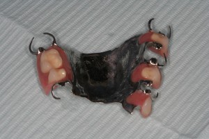 An example of a partial denture